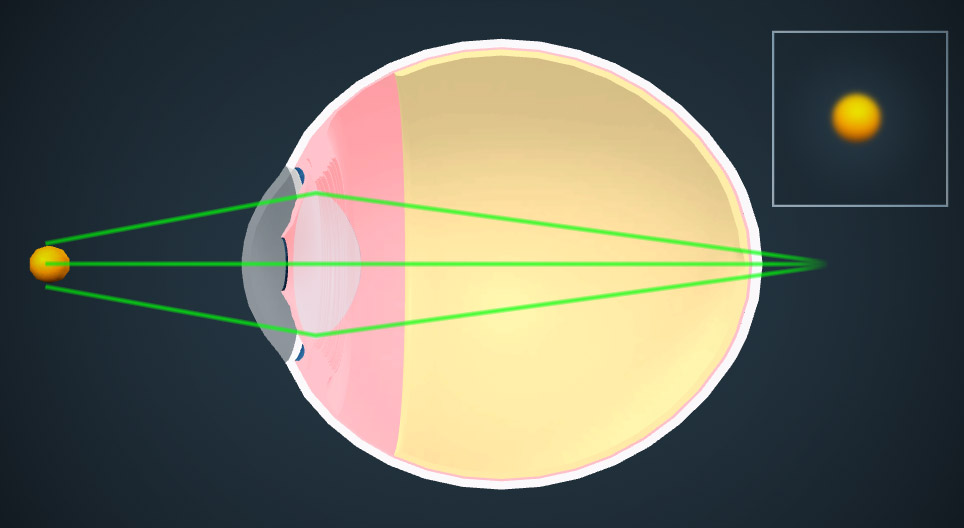 تصحيح الرؤية