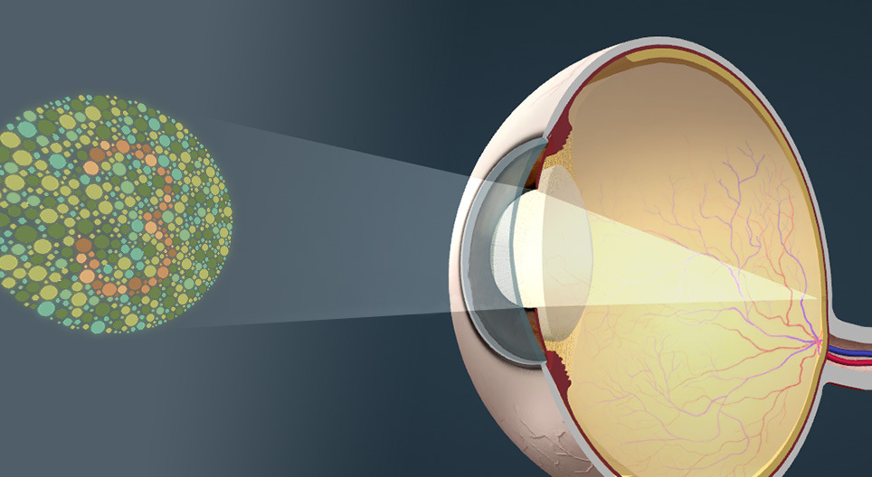 خلل رؤية الألوان