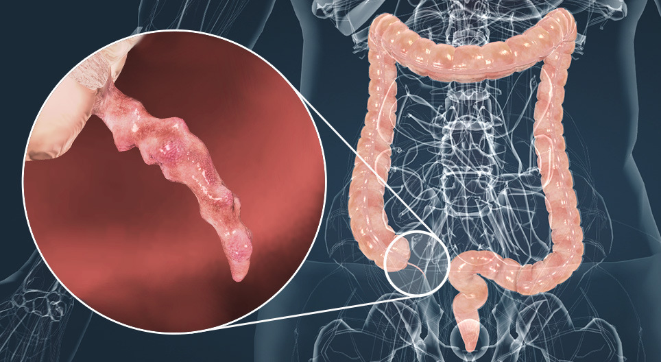 التهاب الزائدة الدودية