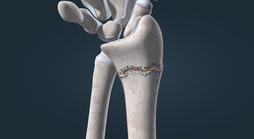 Indirect and direct bone healing