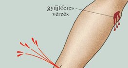 Vérzések típusai