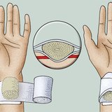 طريقة إعداد الضمادة الشريانية الضاغطة