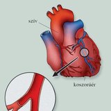 Szívinfarktus kialakulása 