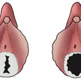 غشاء البكارة لفتاة صغيرة و فتاة بالغة متزوجة
