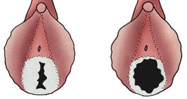 غشاء البكارة لفتاة صغيرة و فتاة بالغة متزوجة