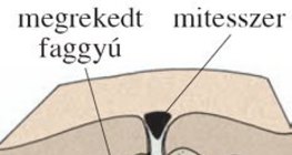 Mitesszer