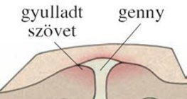 Pattanásos bőr