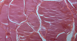 مقطع في الغدة الدرقية