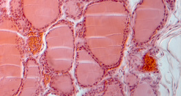 مقطع في الغدة الدرقية