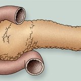 غدة البنكرياس